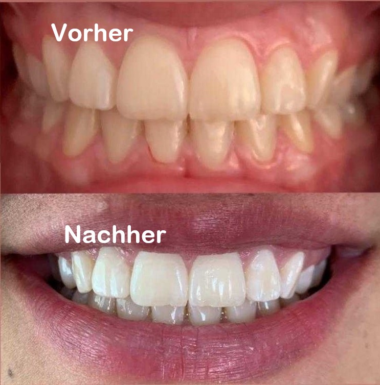 SHR Germany Zahnbleaching Behandlungsset